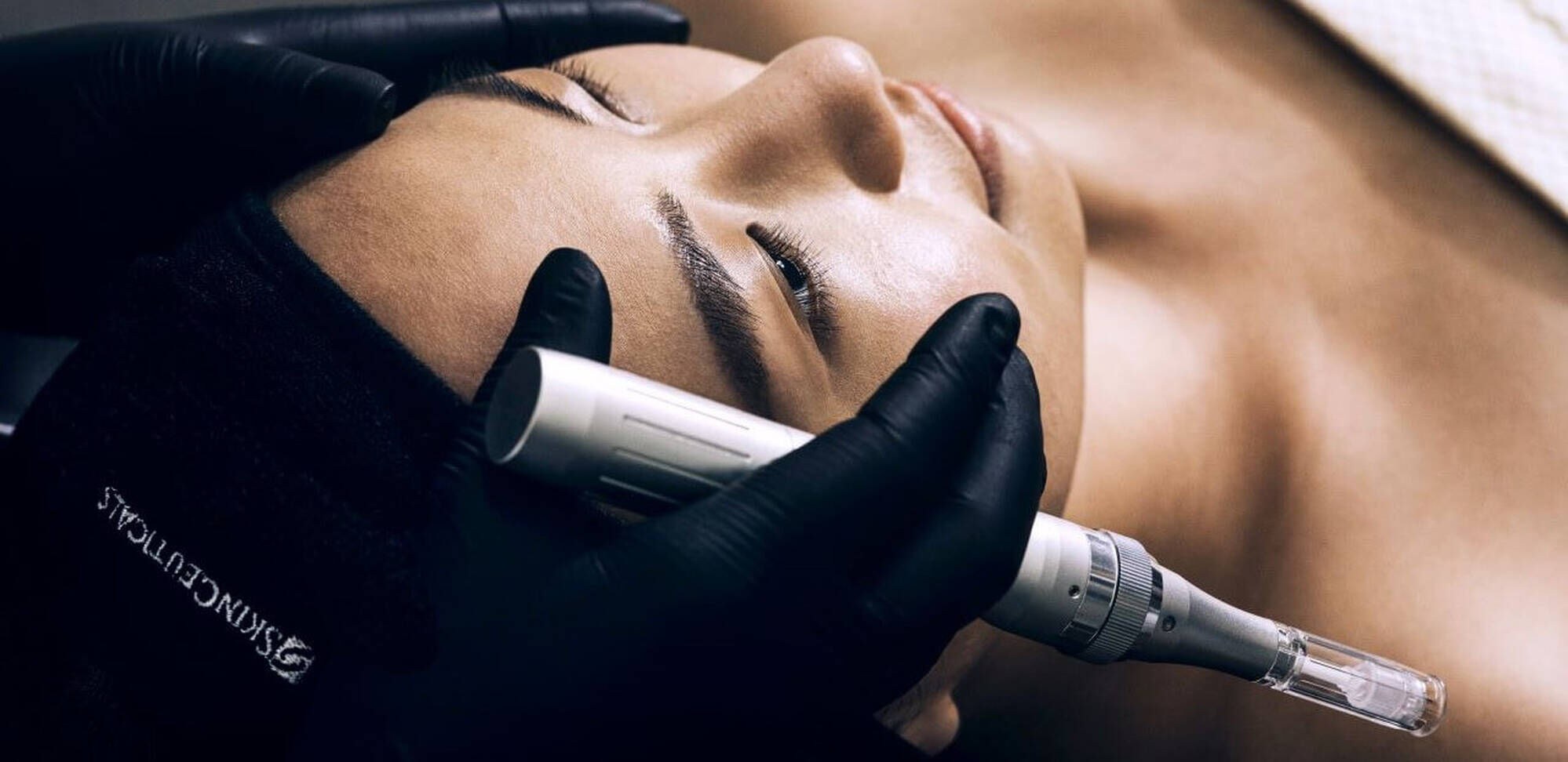 Microneedling