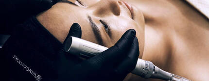 Microneedling