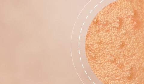 Close-up of textured skin with small bumps, set against a soft, blurred background.