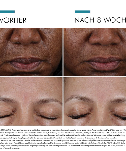 Vorher-Nachher-Vergleich der Haut einer Frau nach 8 Wochen Behandlung zur Verbesserung des Hautbildes.